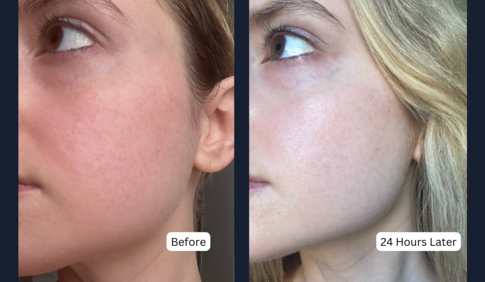 before and after photos showing the author's face looking much less red 24 hours after using the liquid exfoliant