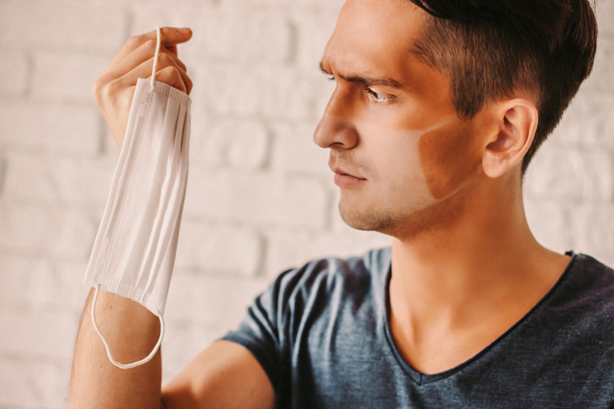 A mask sunburn after forgetting to apply daily sunscreen. (Getty Images)