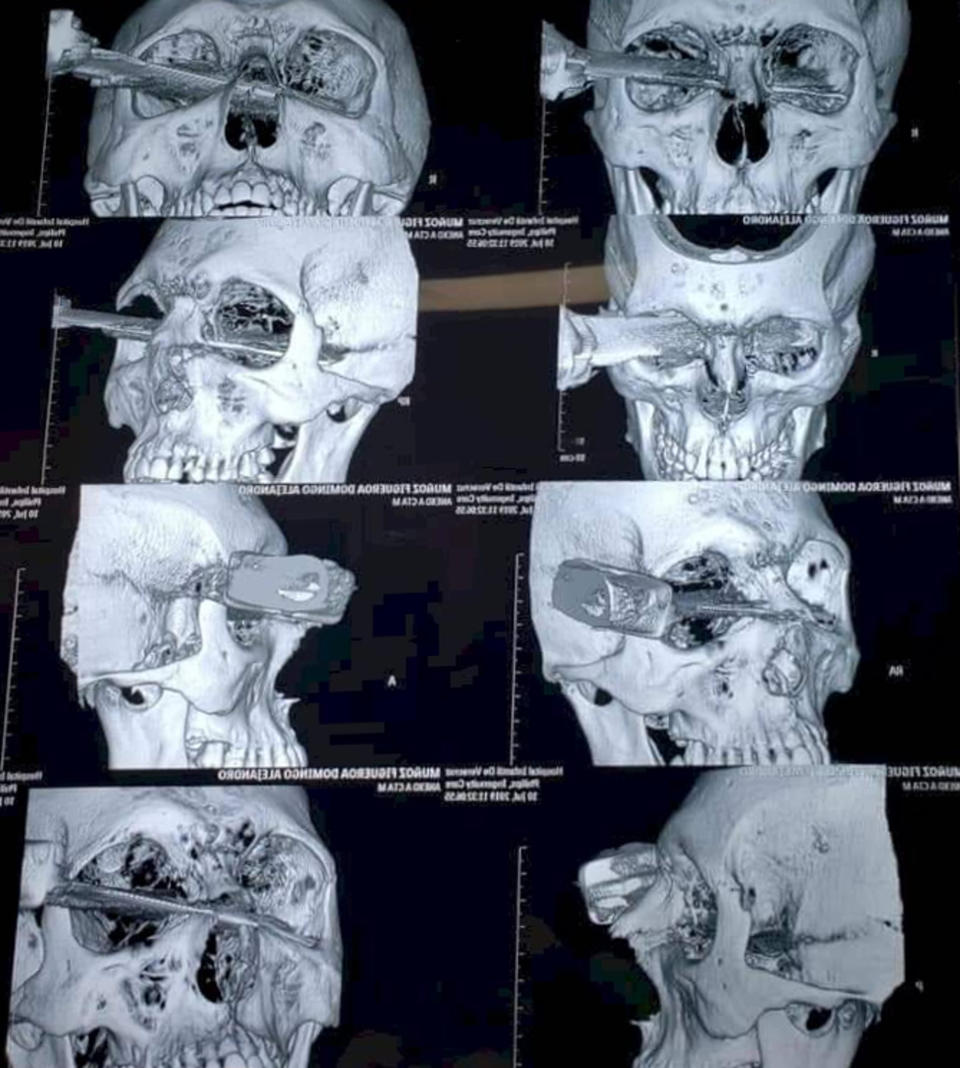 Pic shows: The Xray with the knife footage  These images show a man with a knife sticking out of his eye after he was stabbed in an argument over a parking space at a shopping centre.