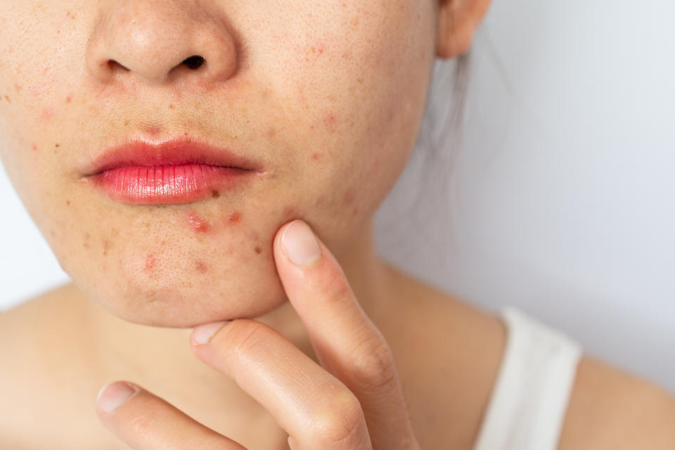 Sign 2 of high androgen: Acne skin and oily skin are prone to acne, pimples, cysts and other symptoms due to increased secretion of sebaceous glands, especially on the chin, back and chest.