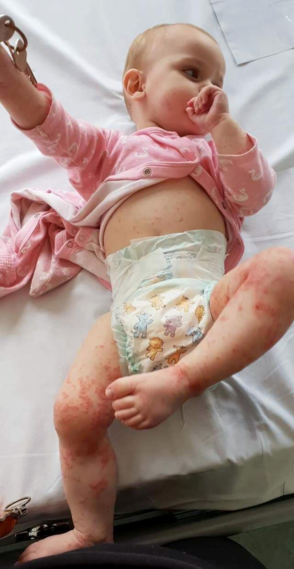 One-year-old Kaylah Merritt developed a painful rash after being kissed by a family member while they had a cold sore [Photo: Caters]