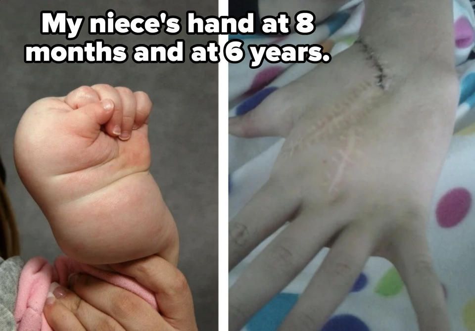Two images: left shows a baby's hand gripping an adult's finger; right shows an arm with surgical stitching