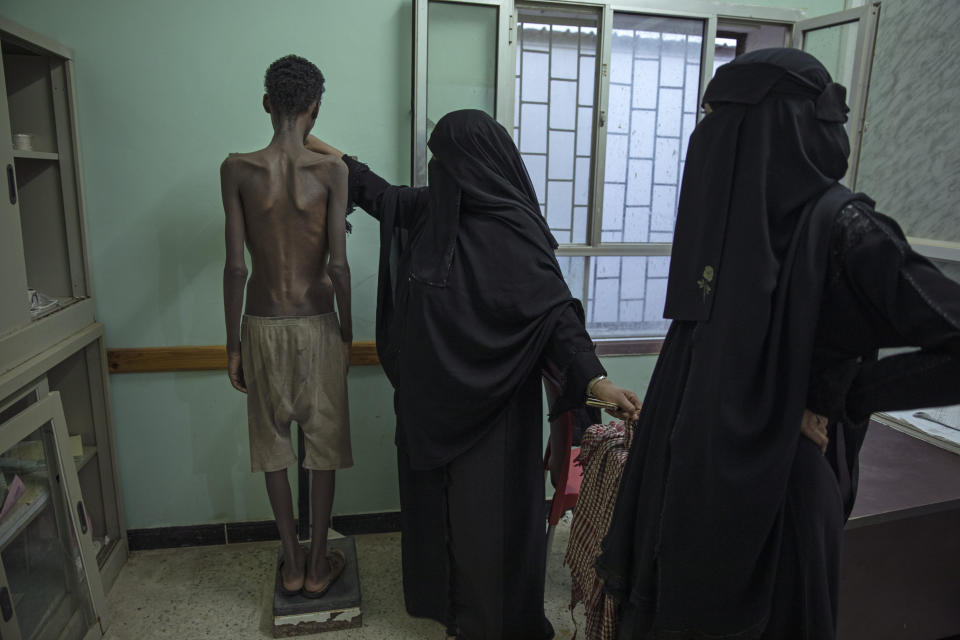 In this Aug. 1, 2019 photo, 19-year-old Ethiopian migrant Mohammed Hussein, who is severely malnourished from imprisonment by smugglers, stands on a scale at the Ras al-Ara Hospital in Lahj, Yemen. He weighs 31 kilograms (68 pounds). Starvation is a punishment used by the traffickers to wear down their victims. (AP Photo/Nariman El-Mofty)