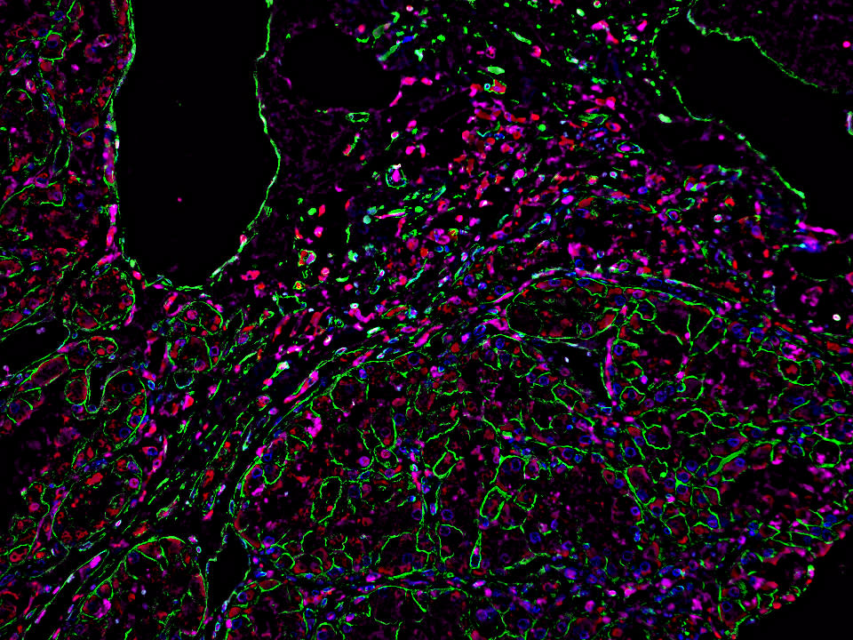 A microscopic image of macrophages in a kidney cancer tumour (Dr Jackie Bader, PhD/VUMC/PA)