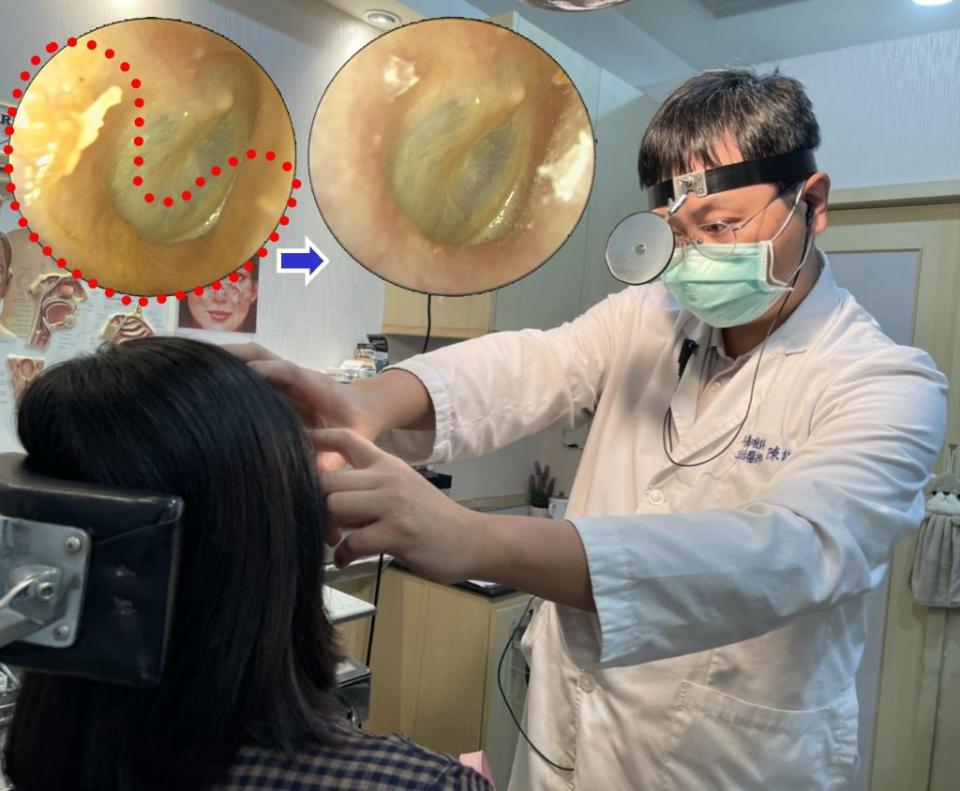 陳建志醫師為患者移除黏著於外耳道及耳膜上的耳垢 （圖左上紅圈）。 （陳建志醫師提供）