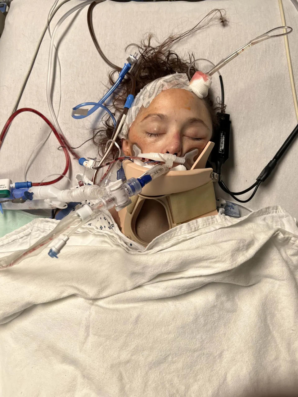 Rachel Foster had to undergo emergency surgery after an electric scooter accident left her with a catastrophic brain injury. (Credit: Rachel and John Foster) 
