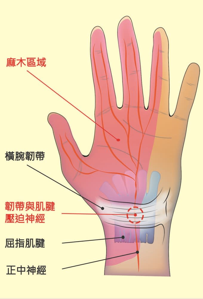 腕隧道症候群肇因於手腕處周邊神經受壓迫，導致手指出現麻木感。