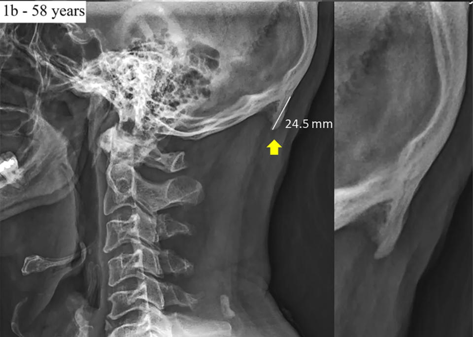 External occipital protuberance X-ray: A 24.5mm growth is seen on the back of the skull of a 58-year-old, blamed on poor posture as a result of ageing. 