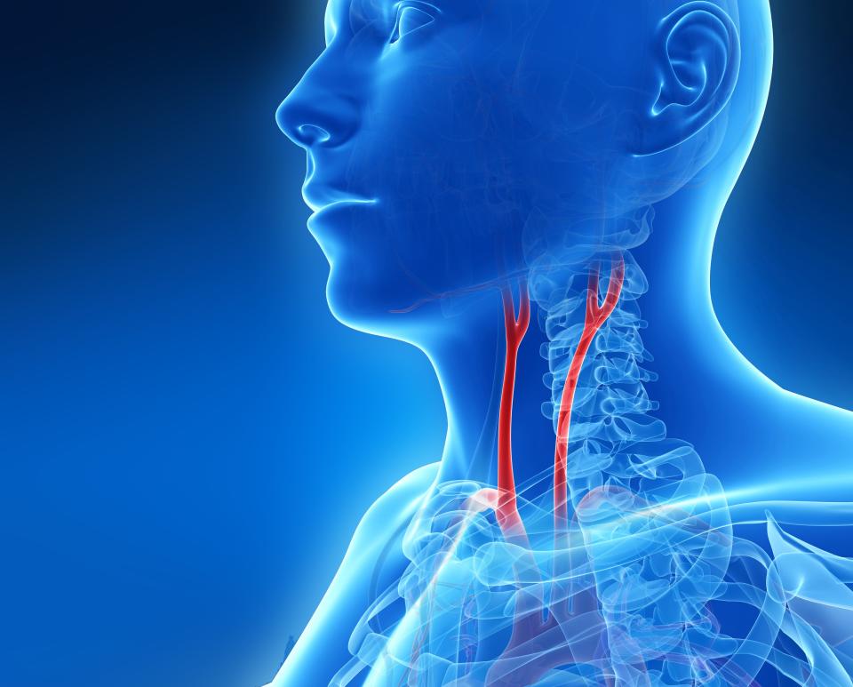 Carotid artery disease is a form of atherosclerosis, or a buildup of plaque, in the two main arteries in the neck that supply oxygen-rich blood to the brain.