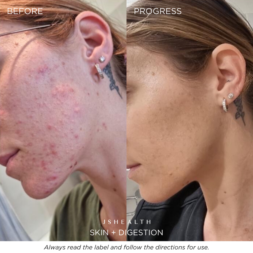 Before and after photos of a woman's skin