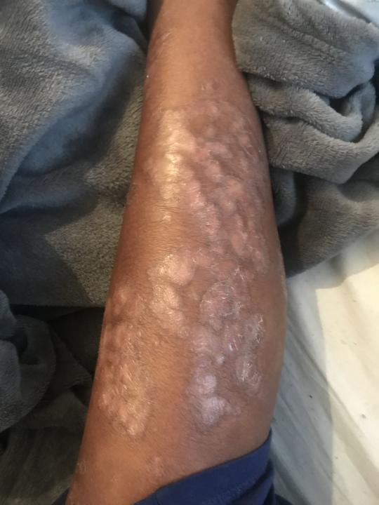 Psoriasis patient leg