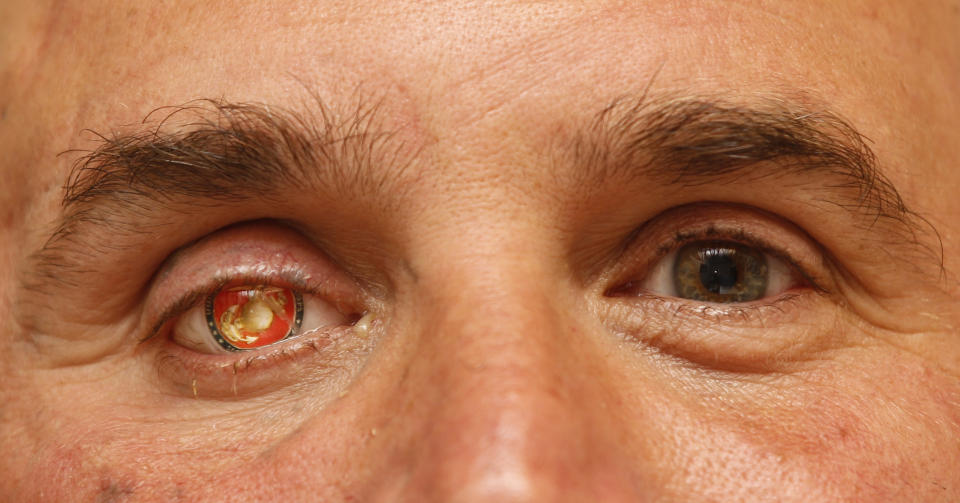 In this Monday, Sept. 17, 2012 file photo, Nick Popaditch, a Republican congressional candidate in the California's 53rd District, poses for a photo showing his Marine Corps insignia in his right eye in La Mesa, Calif. Popaditch, who was injured in Iraq on April 7, 2004, when shrapnel tore through his sinuses and destroyed his right eye, says, "...if the bad guys come back into control, that's not something I can control 8,000 miles away here. I'm just proud of the fact that when it came time to stand and fight for those things, those concepts of freedom, liberty, human rights ... I'm glad my nation did it." (AP Photo/Lenny Ignelzi)