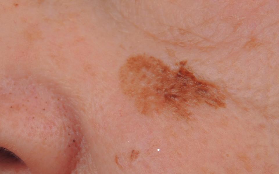 Lentigo melanoma is commonly found in facial areas