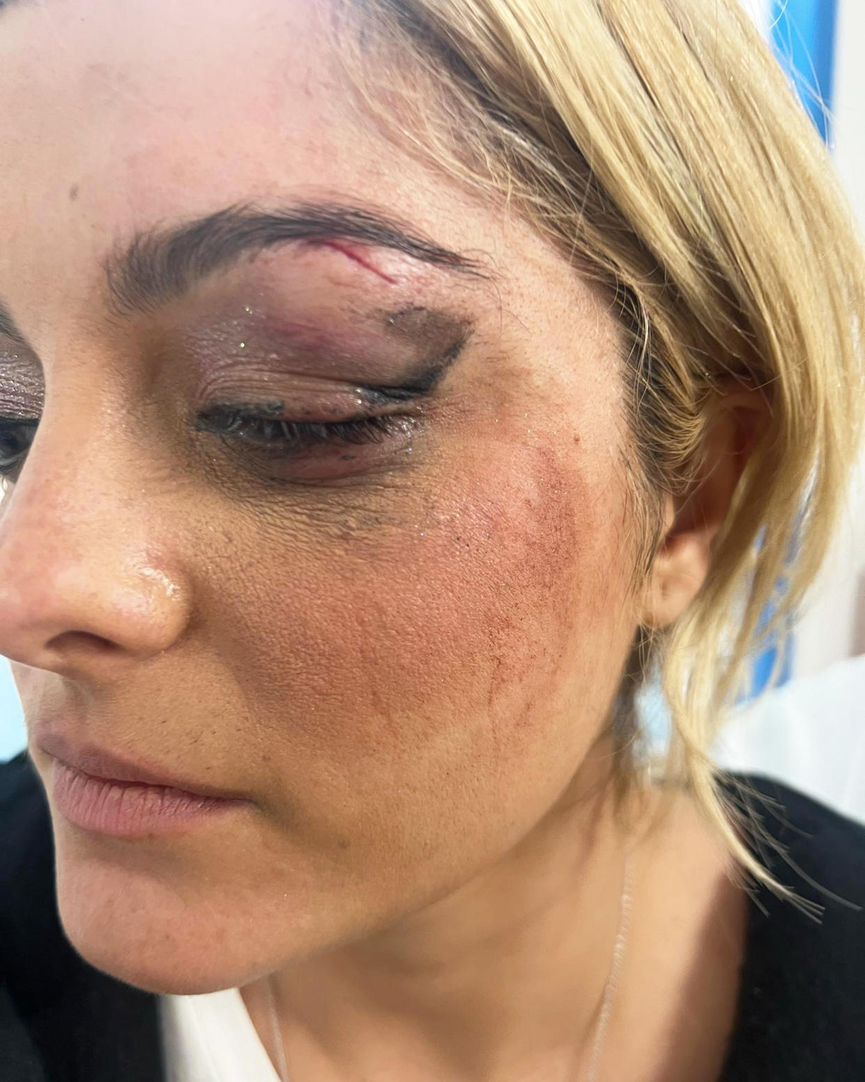 Bebe Rexha shows her injured face after a concertgoer whipped a cell phone at her head during a concert in New York on Sunday. (@beberexha via Instagram)