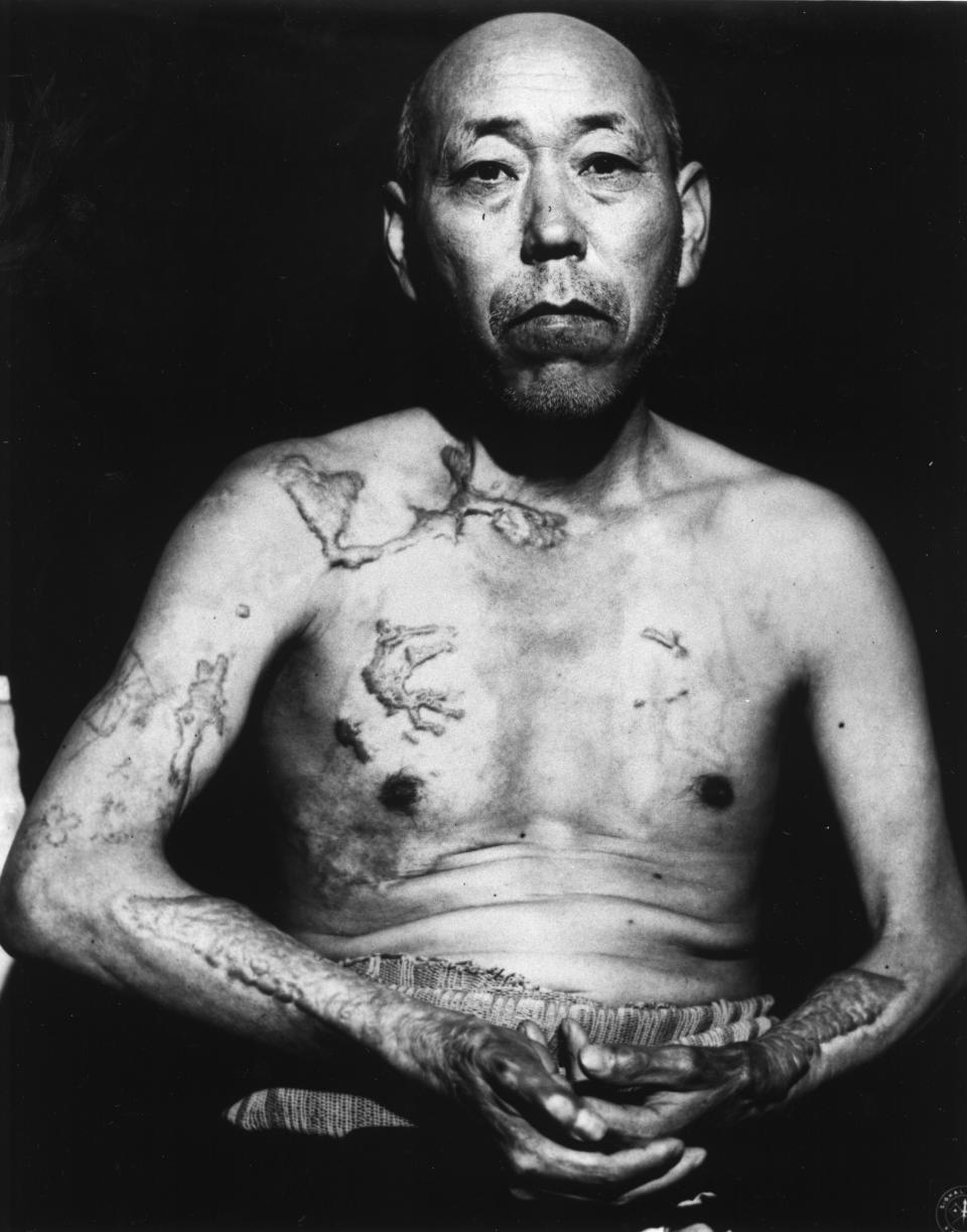 Jinpe Teravama, sobreviviente del bombardeo atómico en Hiroshima, muestra las quemaduras que sufrió en una foto tomada en 1947, dos años después del estallido. (AP Photo)