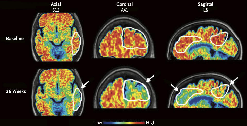 These PET scan images provided by the New England Journal of Medicine in January 2024 show a reduction in amyloid-beta levels in an Alzheimer's patient after focused ultrasound treatment to open the blood-brain barrier after 26 weeks. Red is associated with higher levels of amyloid-beta levels. Scientists have found a way to help Alzheimer’s drugs seep inside the brain faster _ by temporarily breaching its protective shield. (New England Journal of Medicine via AP)