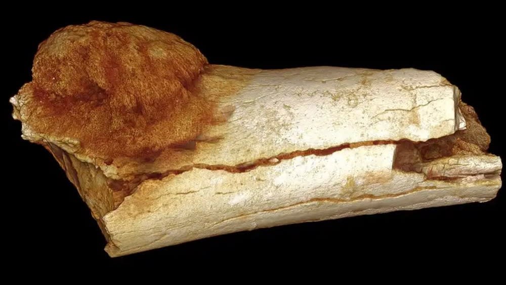  A prehistoric toe bone that contains cancer. On the left side of the bone we see a lumpy mass. 