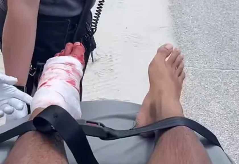 A shark bit Palm Bay surfer Chris Pospisil's left foot and ankle July 14 in New Smyrna Beach.