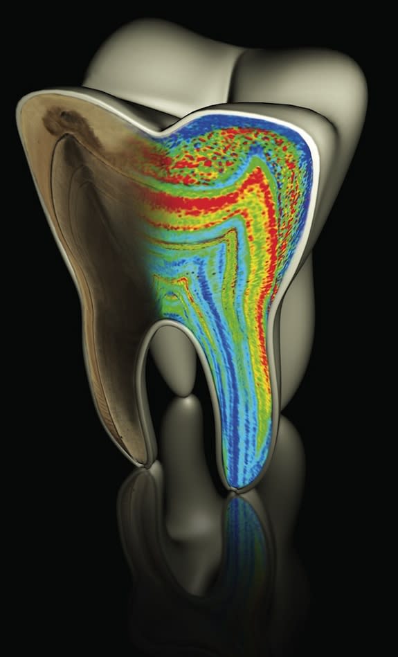 A molar tooth model showing color-coded barium patterns.