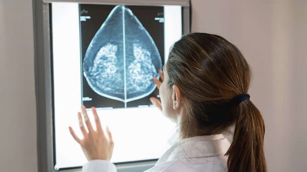 PHOTO: This stock image shows a doctor looking at her patient's mammogram. (Andresr/Getty Images)