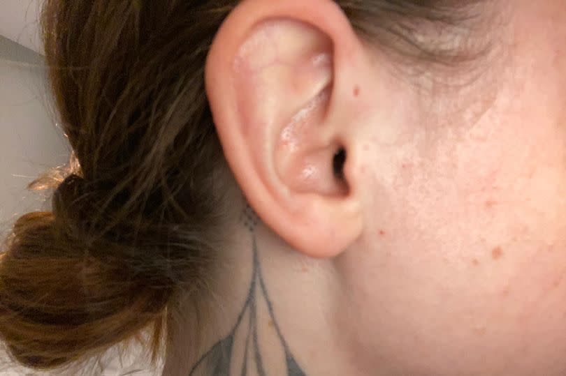 The side profile of a person's face - the ear shows a preauricular pit