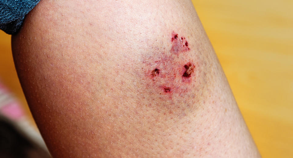 People exposed to the bacteria through bites and scratches to their skin will also develop an ulcer at the wound. Source: File/Getty Images