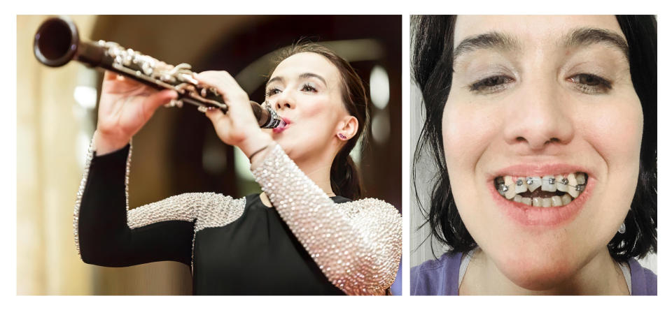 Boja Kragulj, an accomplished clarinetist, says she used the AGGA (Anterior Growth Guidance Appliance) in hopes of correcting her misaligned bite and improving her breathing without surgery. Kragulj has alleged in an ongoing lawsuit that the unproven and unregulated device caused catastrophic harm to her teeth. AGGA inventor Dr. Steve Galella and his company have denied all liability. / Credit: Makris Music Society; Boja Kragulj