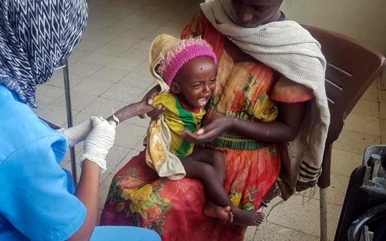 Medhin Gereziher, 1, is treated for malnutrition at the Ayder Referral Hospital in Mekele, in the Tigray region of northern Ethiopia