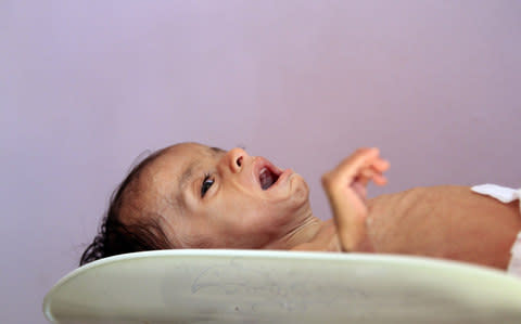 A malnourished Yemeni child receives treatment at a hospital in Sanaa, the capital of Yemen - Credit:  MOHAMMED HUWAIS/AFP