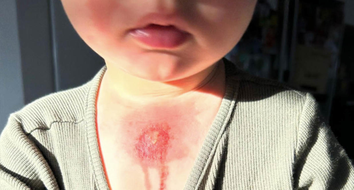 Parents urged to never give kids hot water bottles after 'alarming' spike  in number suffering serious burns