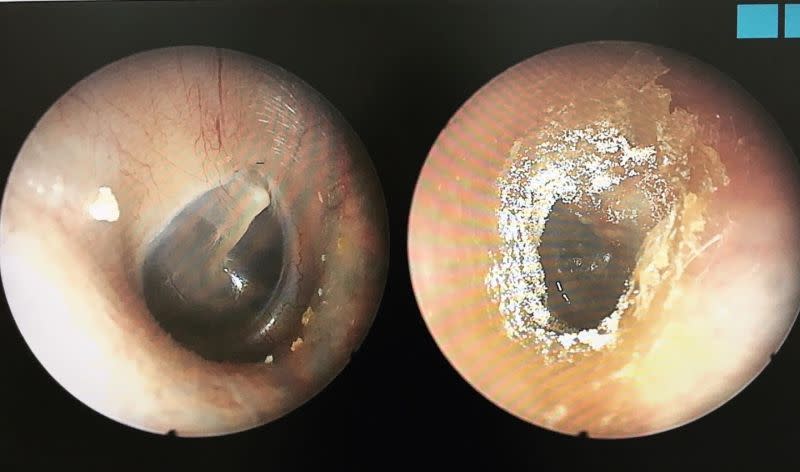 ▲張益豪指出，若耳屎出現白黑相間、棉花樣外觀（圖右），可能是遭黴菌感染，建議就醫接受治療。左圖為正常耳道。（圖／張益豪提供）