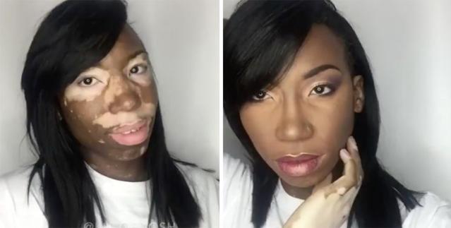 Vitiligo Changed This Makeup