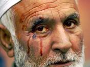 Kashmiri Ghulam Mohammed Matta looks on after he was beaten by police during a demonstration in Srinagar, India, Tuesday, Nov. 21, 2006. Hundreds of Muslims shouted slogans against the government after they were denied travel permits for the annual Haj pilgrimage, reportedly because of an administrative miscommunication. (AP Photo/Rafiq Maqbool)