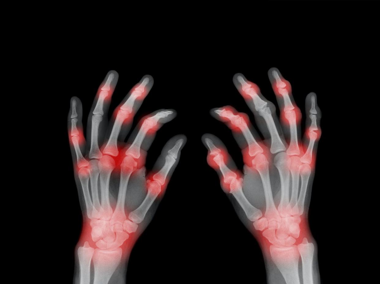 Rheumatoid arthritis leads to painful joint inflammation, often in the hands and wrists. <a href="https://www.gettyimages.com/detail/photo/ray-of-painful-hands-royalty-free-image/991972390" rel="nofollow noopener" target="_blank" data-ylk="slk:Peter Dazeley/The Image Bank via Getty Images;elm:context_link;itc:0;sec:content-canvas" class="link ">Peter Dazeley/The Image Bank via Getty Images</a>