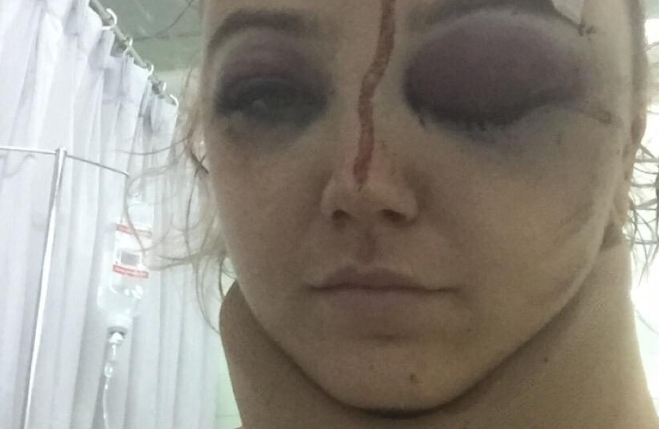 Ms Bell is pictured with two black eyes and blood on her forehead. Source: GoFundMe