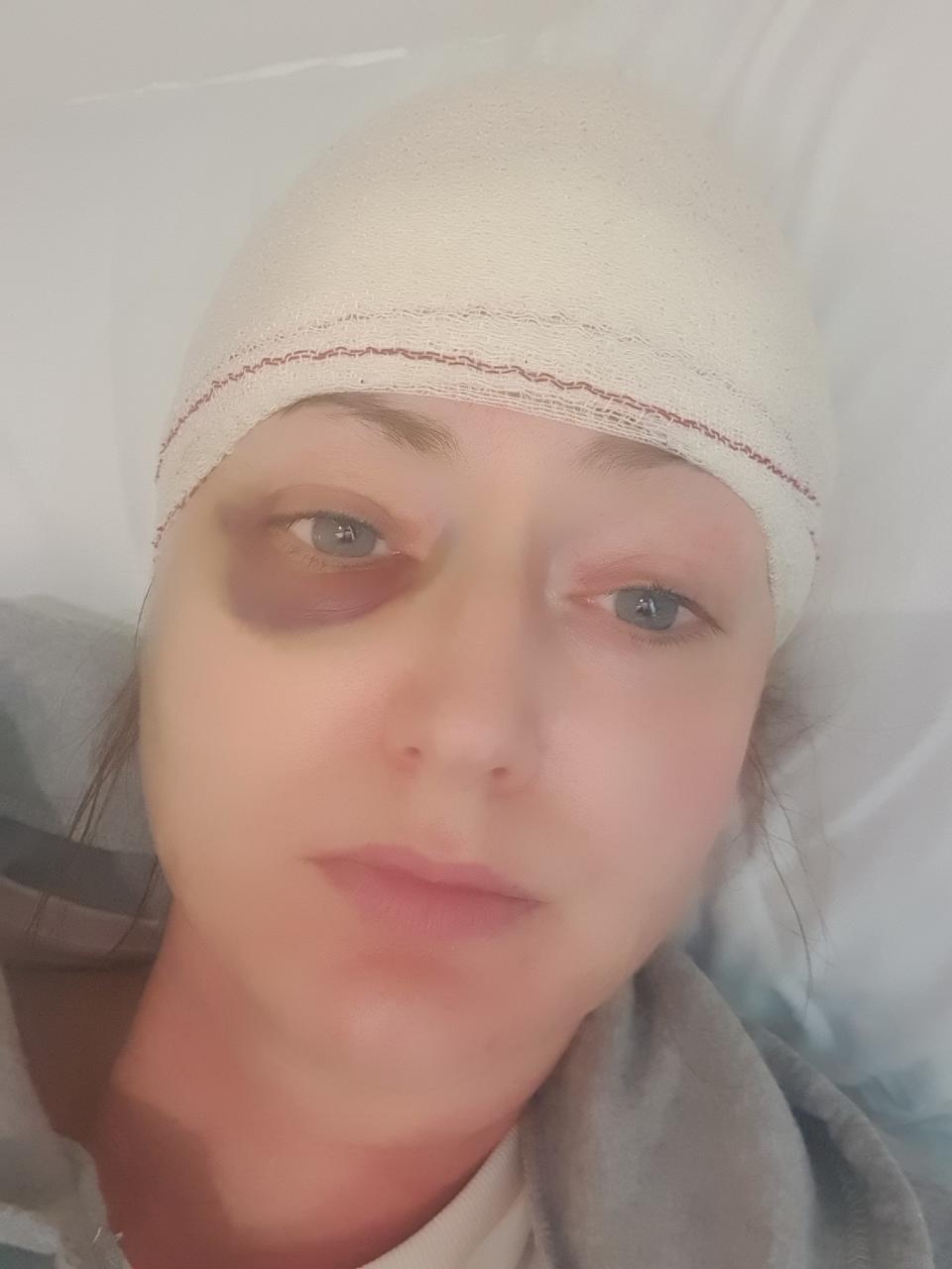 Griffiths pictured two days after her surgery to remove the brain tumour. (Brain Tumour Research/SWNS)