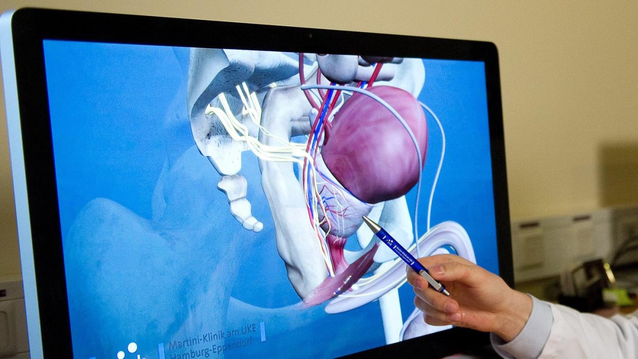 Ein 3D-Modell einer Prostata: Bei der neuen Methode werden Laserfasern in die vom Tumor befallene Region eingebracht. Foto: Axel Heimken