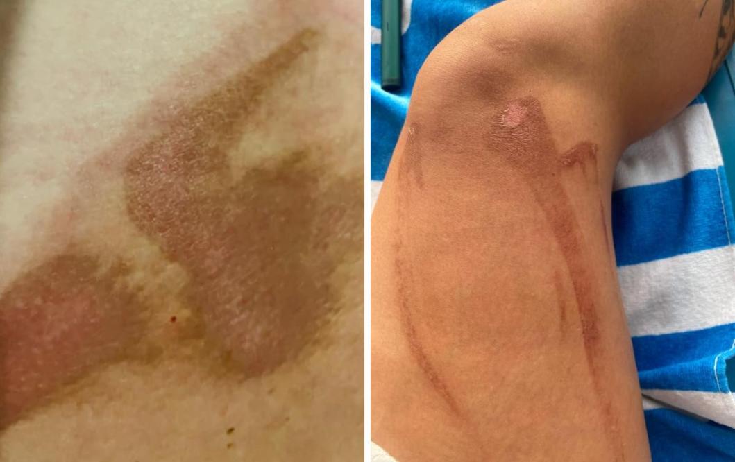 Shocking photos of woman's year-long recovery from a spider bite - NZ Herald