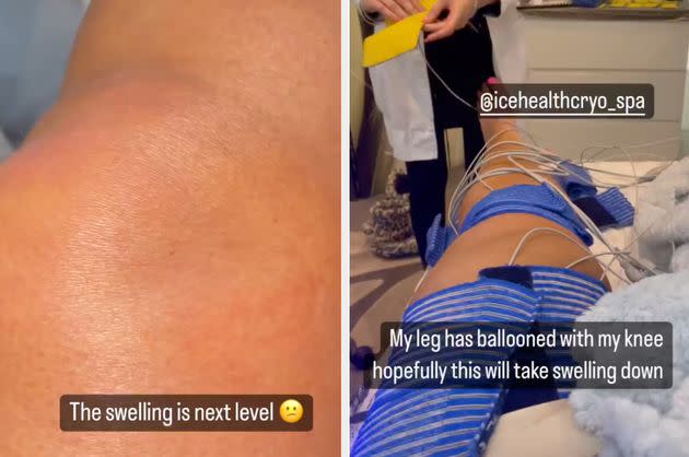 Gemma underwent cryotherapy on her knee on Tuesday (Photo: Instagram/Gemma Collins)