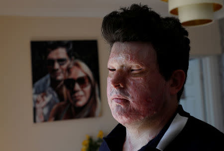 Acid attack victim Andreas Christopheros, poses for a photograph in his home in Truro, south-west England, Britain July 31, 2017. REUTERS/Peter Nicholls