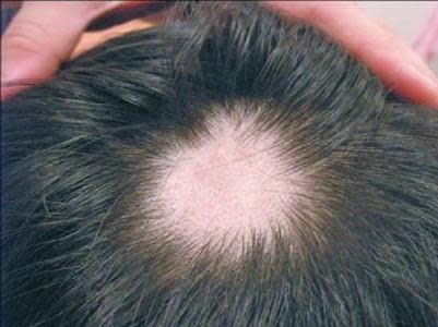 <strong>「鬼剃頭」也就是所謂的「圓禿」是相當常見的疾病，多數患者會自行痊癒，不過有些患者會進展到嚴重掉髮，甚至全頭禿髮。（圖／pixabay）</strong>