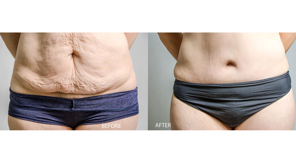 tummy tuck before and after