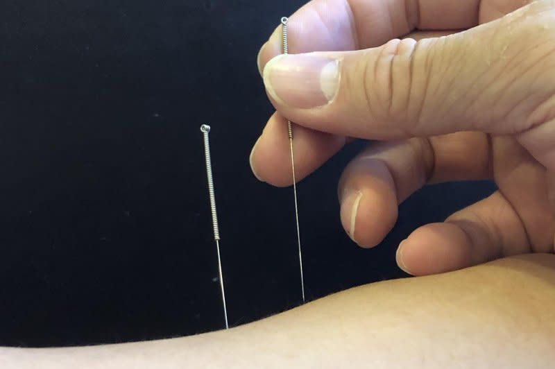 The study revealed the possible long-term effect of acupuncture on stroke prevention. It’s not as expensive as immunosuppressive or biologic medications and should be considered as a standard treatment for rheumatoid arthritis, a key researcher said. Photo courtesy of China Medical University