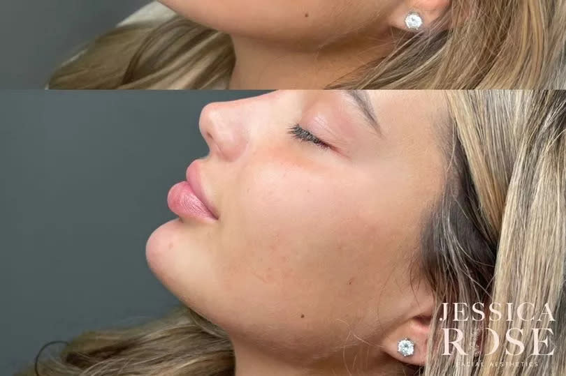 Love Island's Lucinda Strafford showed off the results of her chin augmentation