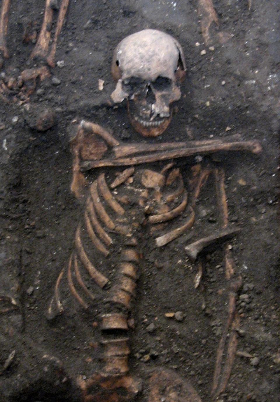 One of the samples of ancient herpes DNA came from a young adult male from the late 14th century, buried in the grounds of medieval Cambridge. The individual had suffered appalling dental abscesses.