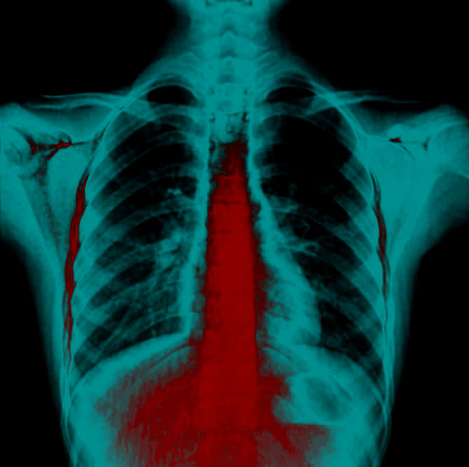 Acid reflux as seen on a diagnostic imaging test.