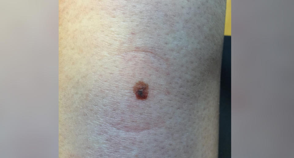 A freckle on her calf turned out to be cancer. Source: Caters