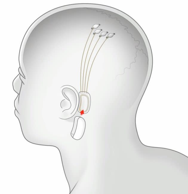 An illustration shows how electrodes could be implanted in a patient’s brain, with wires running under the scalp to a device surgically implanted behind the ear. (Neuralink Illustration)
