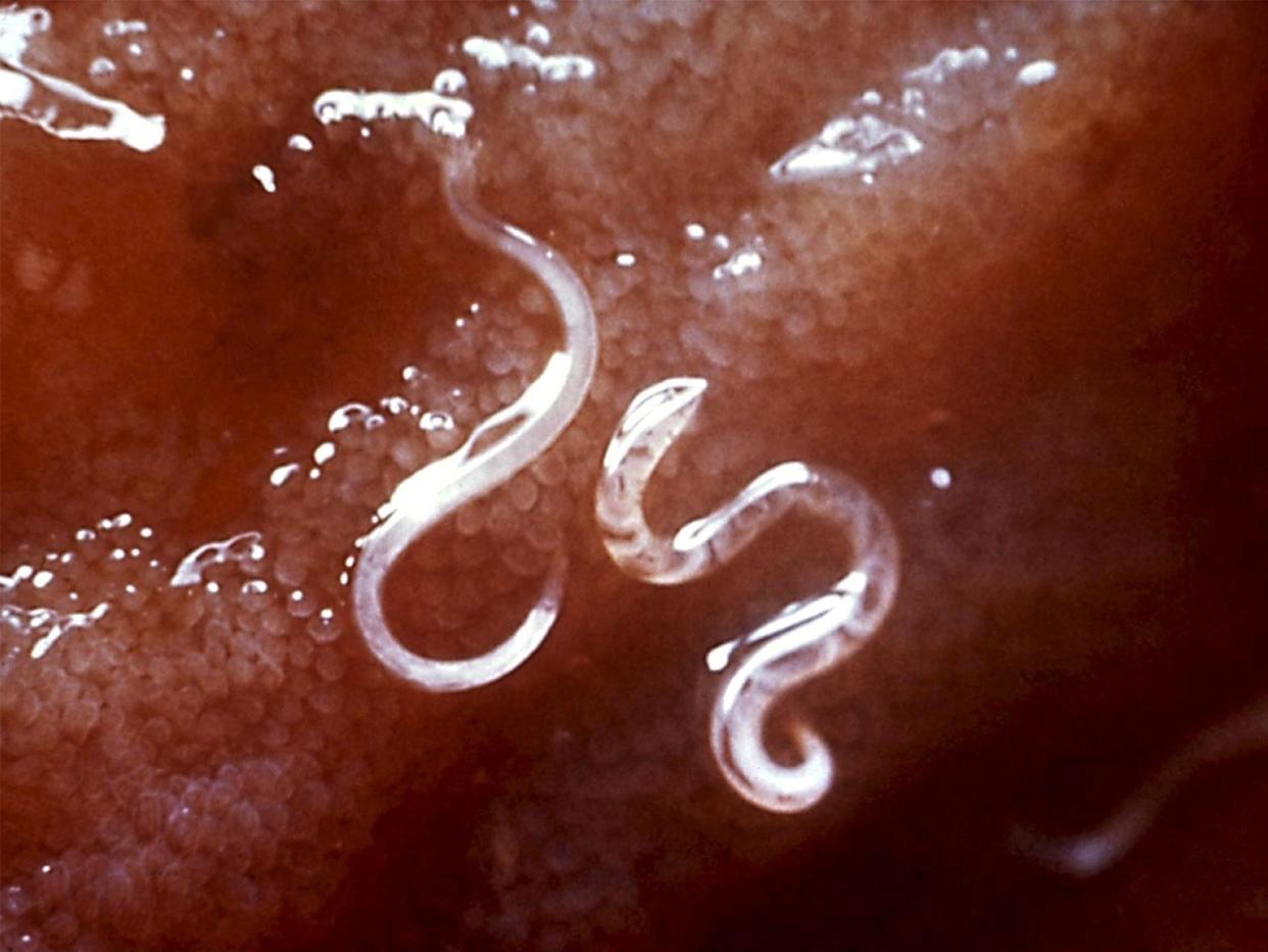 The pair believe they contracted the hookworm larvae parasite while sitting on a beach: Rex