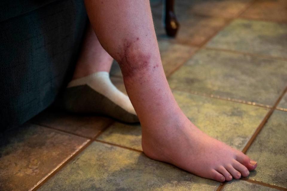 Chris McLarty, 12, shows his healing dog bite at his Jackson County home on Wednesday, June 7, 2023. Chris underwent nine surgeries and was in a wheelchair for weeks after he was severely attacked in February by a neighbor’s pit bull for the second time. Hannah Ruhoff/Sun Herald
